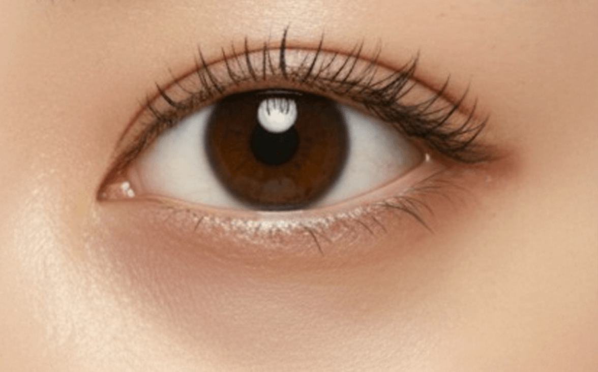 id Hospital - Under Eye Fat Repositioning - Dark Circle Type
