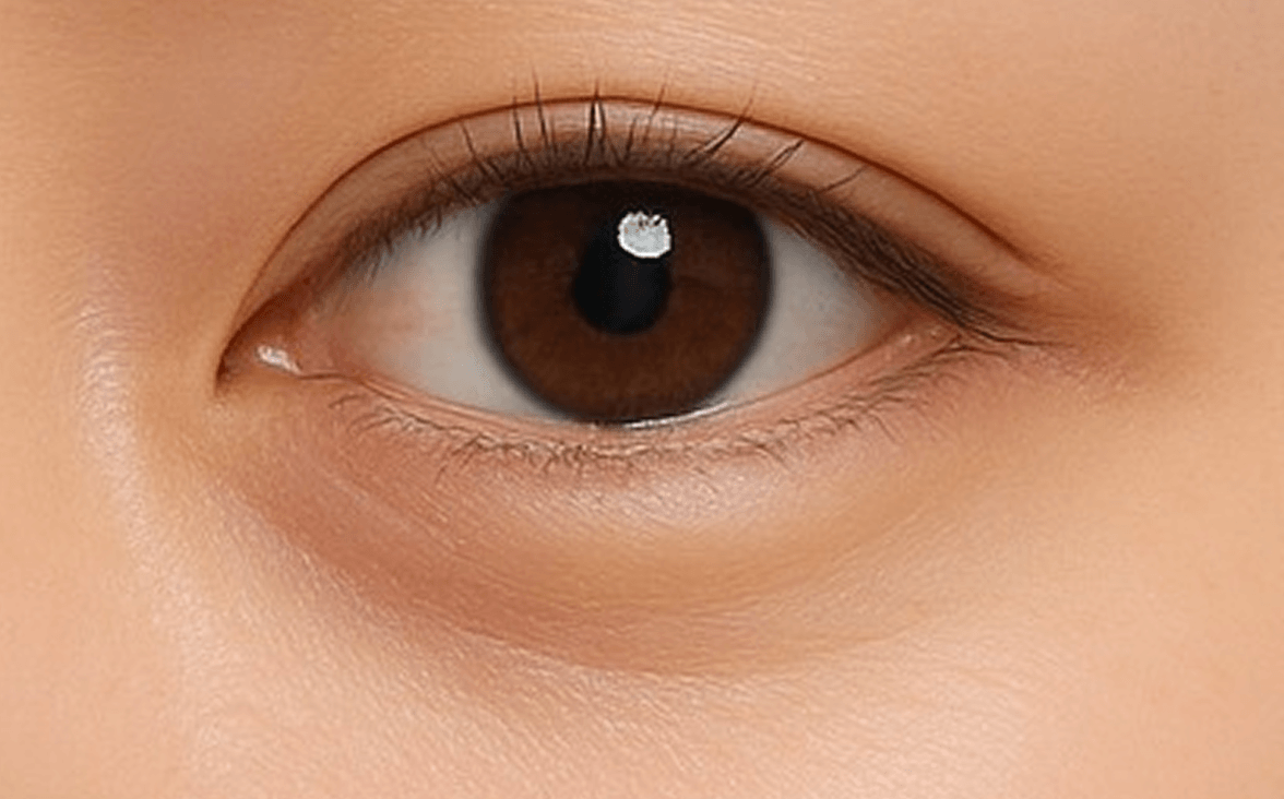 id Hospital - Under Eye Fat Repositioning - Fat Protrusion