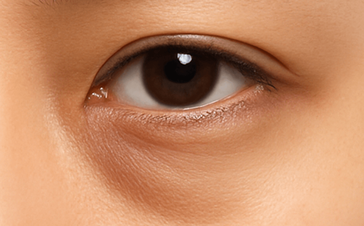 id Hospital - Under Eye Fat Repositioning - Fat Hollowing