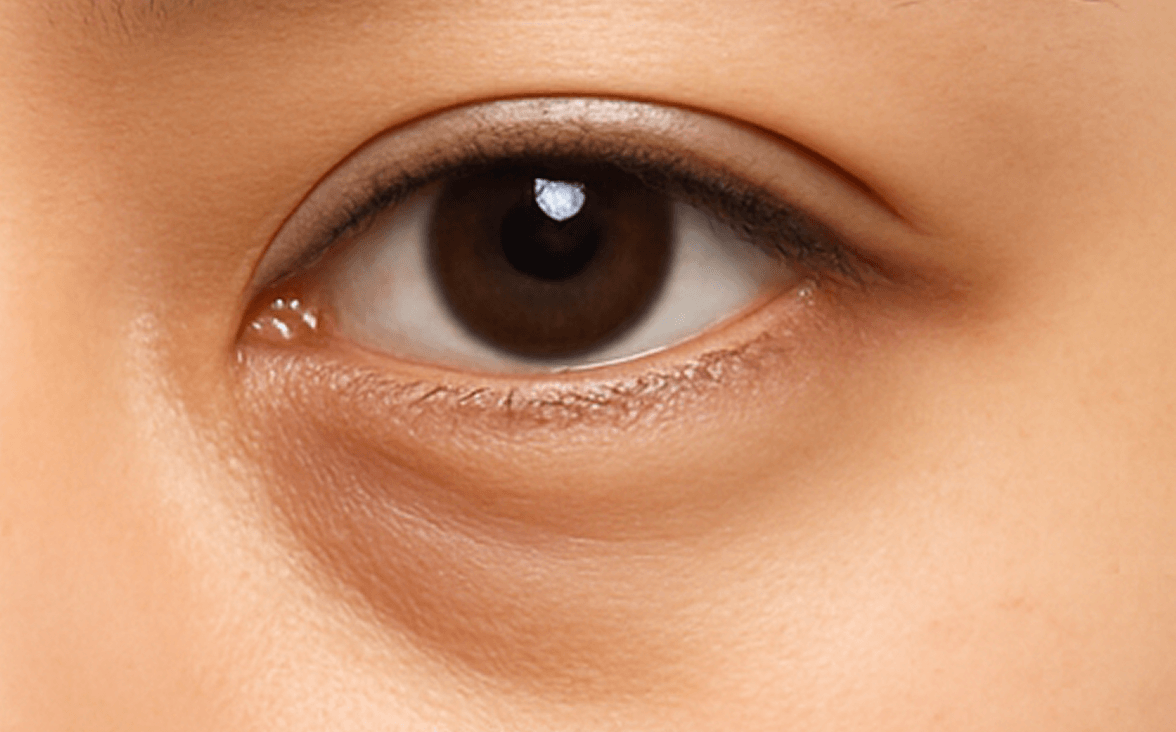 id Hospital - Under Eye Fat Repositioning - Protrusion + Hollowing