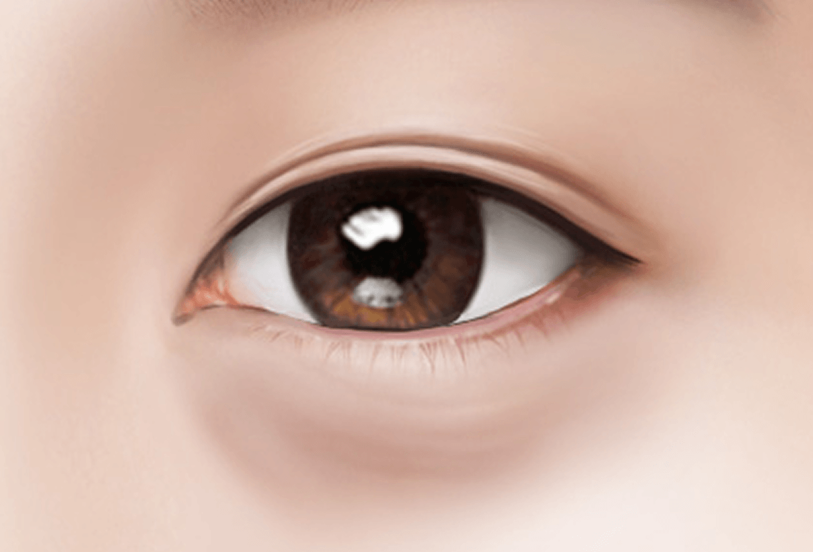 id Hospital - Under Eye Fat Repositioning - Surgical Method Step 1
