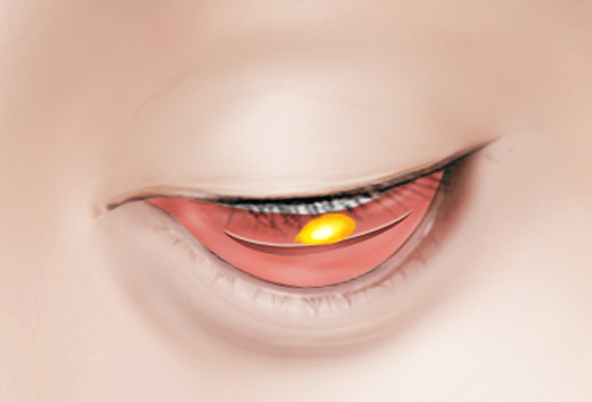 id Hospital - Under Eye Fat Repositioning - Surgical Method Step 2
