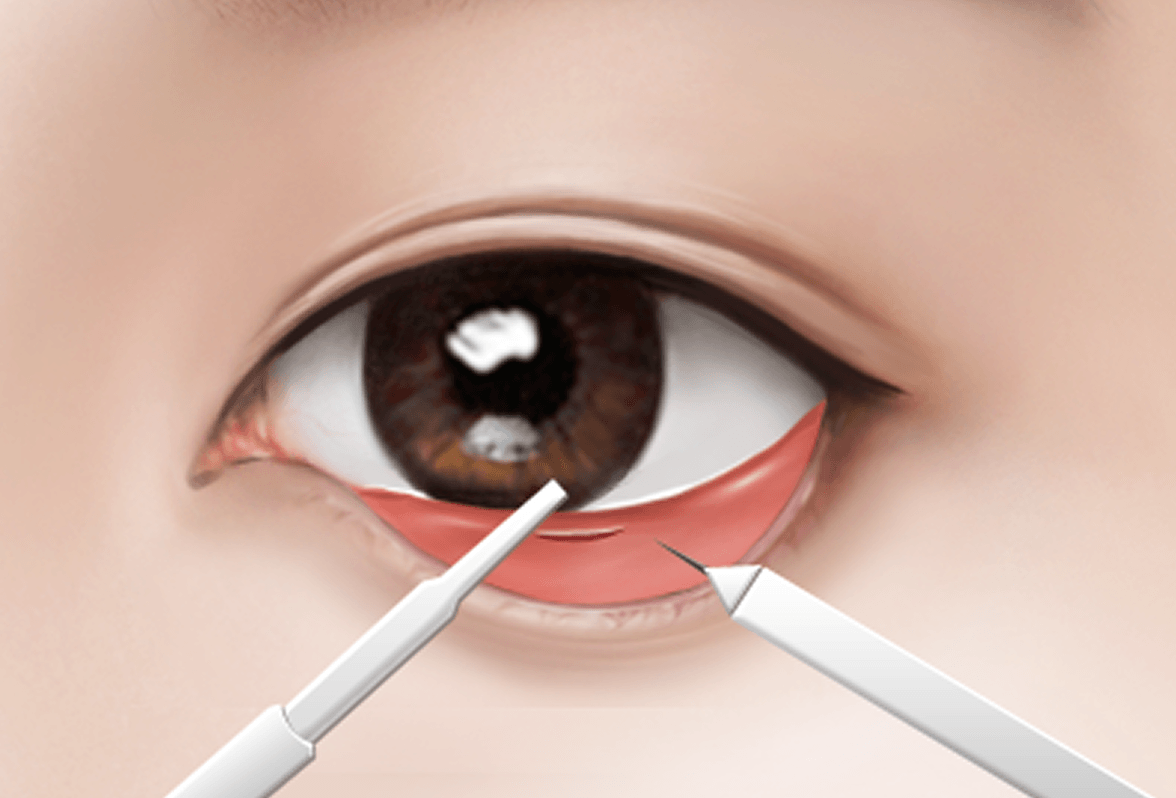 id Hospital - Under Eye Fat Repositioning - Surgical Method Step 3