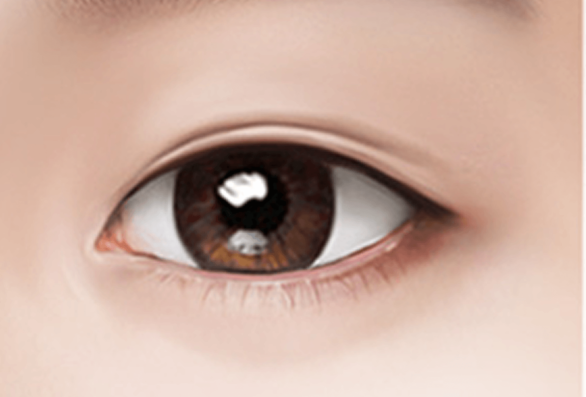 id Hospital - Under Eye Fat Repositioning - Surgical Method Step 4