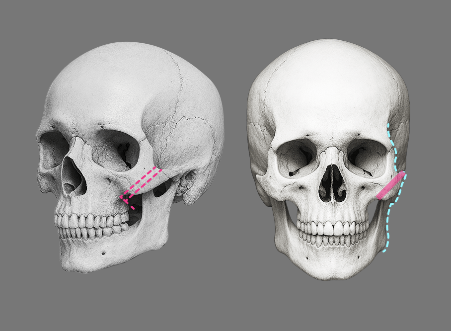 id Hospital - High-L Cheekbone Reduction - L Osteotomy Low-L Conventional