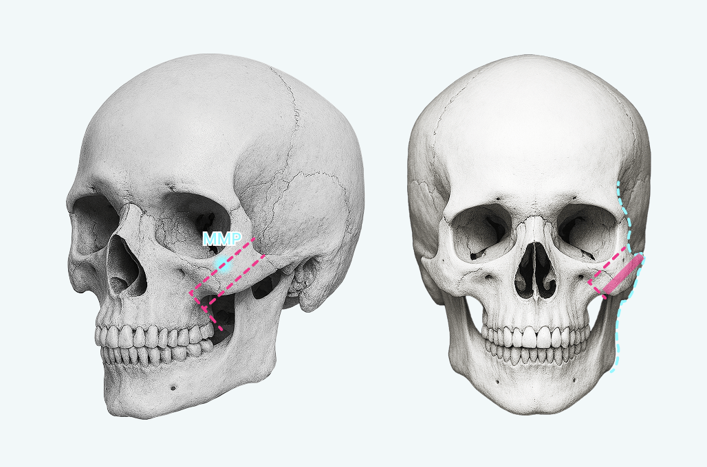 id Hospital - High-L Cheekbone Reduction - id High-L Osteotomy