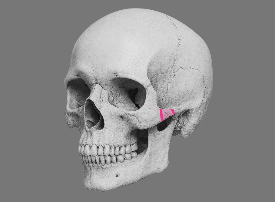 id Hospital - High-L Cheekbone Reduction - Conventional Method