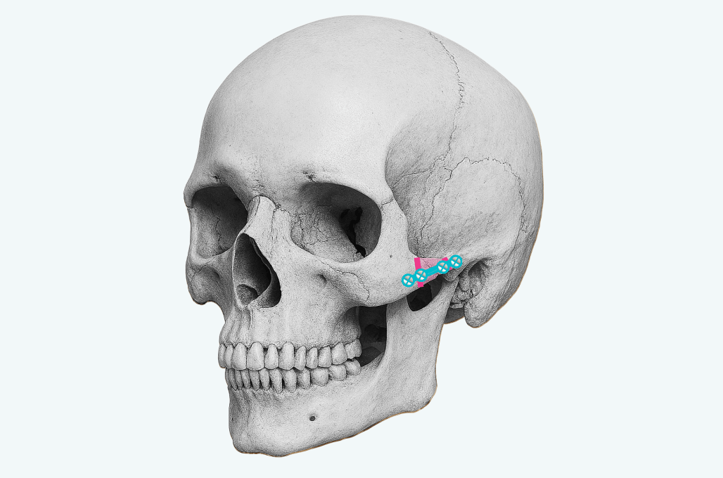 id Hospital - High-L Cheekbone Reduction - id Quick Cheekbone Reduction