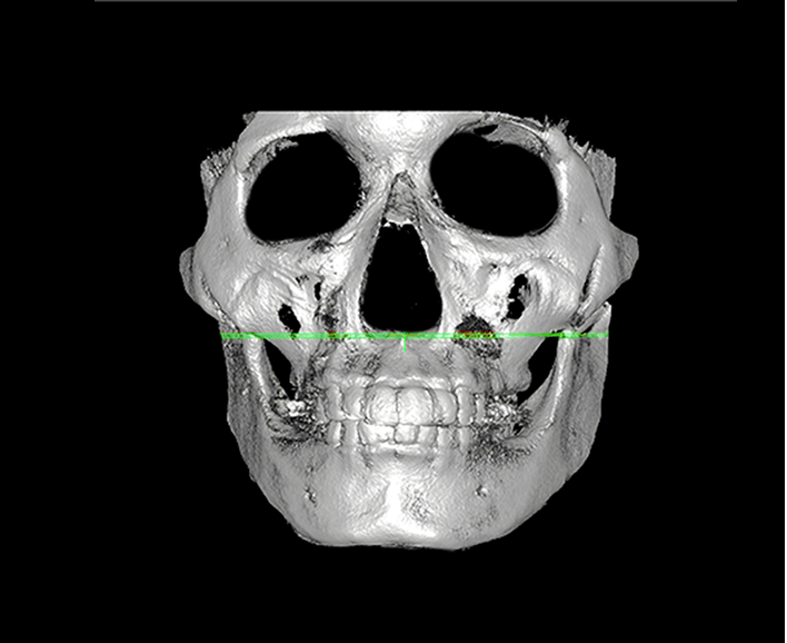 id Hospital - Revision Facial Contouring - Cheekbone Before
