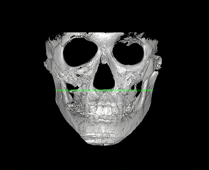 id Hospital - Revision Facial Contouring - Cheekbone After