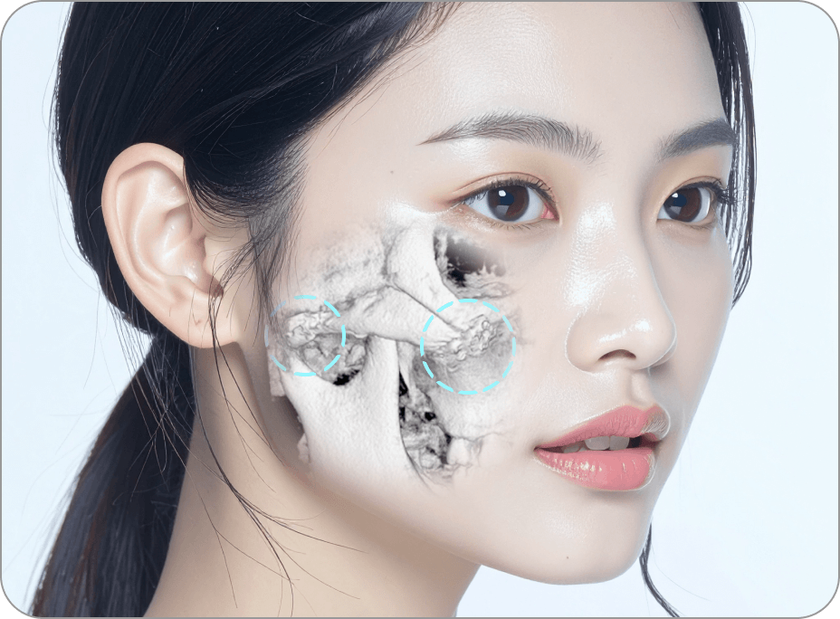 id Hospital - 3 Types of Facial Contouring - Cheekbone Reduction Step 3