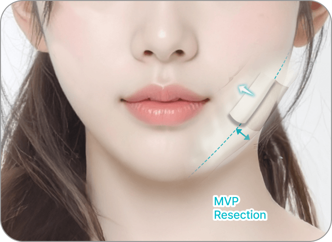 id Hospital - 3 Types of Facial Contouring - Curved-Line Mandibular Angle Resection