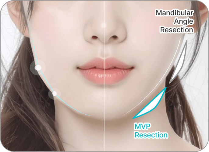 id Hospital - 3 Types of Facial Contouring - Cortical Bone Resection