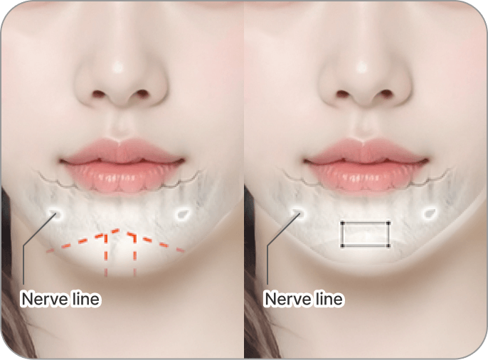 id Hospital - 3 Types of Facial Contouring - Chin tip is blunt and wide