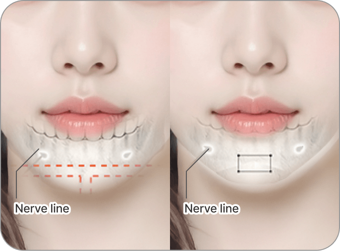 id Hospital - 3 Types of Facial Contouring - Chin tip is long and makes the face look long