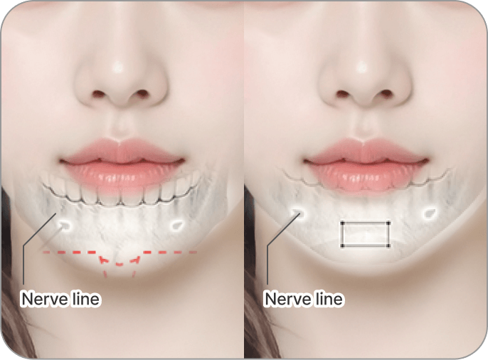 id Hospital - 3 Types of Facial Contouring - Chin is short and blunt