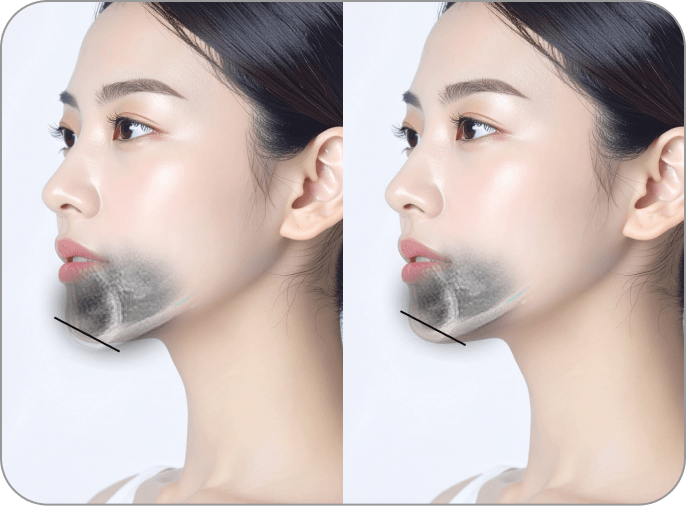 id Hospital - 3 Types of Facial Contouring - Bite is normal but the chin tip is asymmetrical