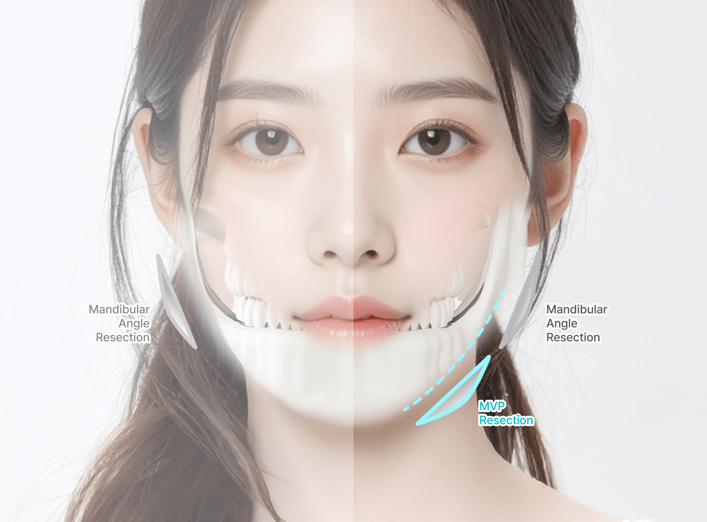 id Hospital - MVP Mandible Reduction - Conventional vs MVP Square Jaw Reduction