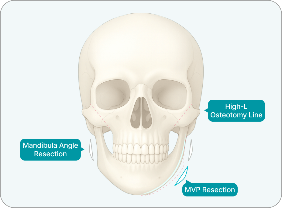 id Hospital - Revision Facial Contouring - Resolving the Maximum Volume Areas of the Cheekbone and Jaw