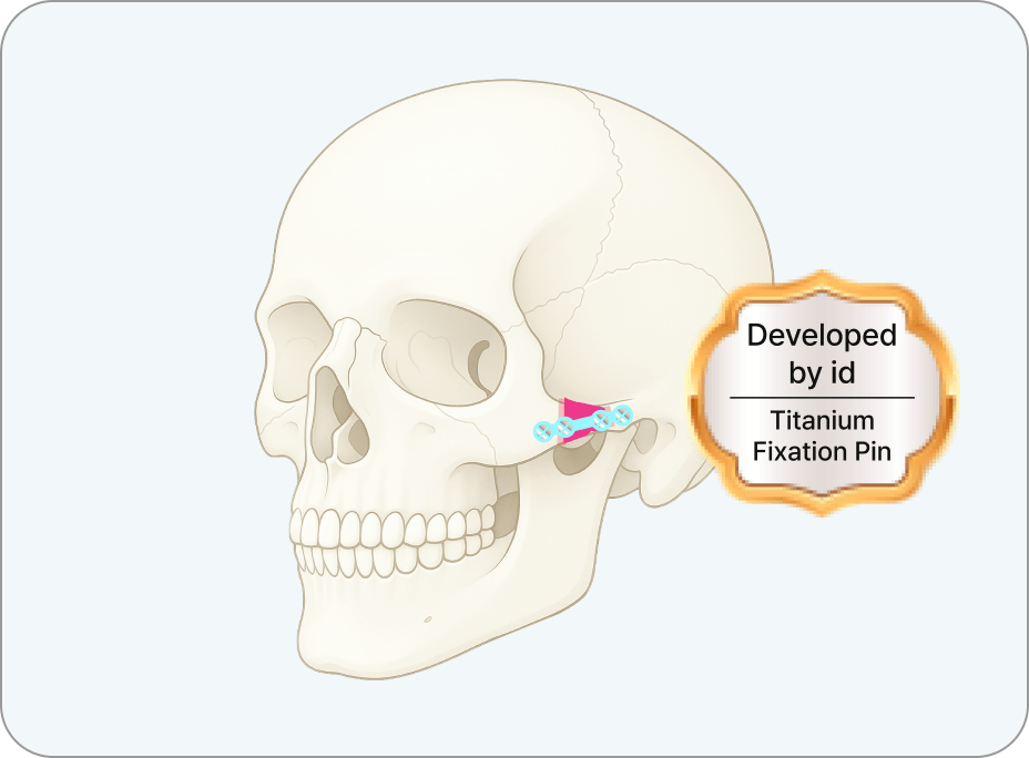 id Hospital - Revision Facial Contouring - Secure Fixation without Risk of Loosening