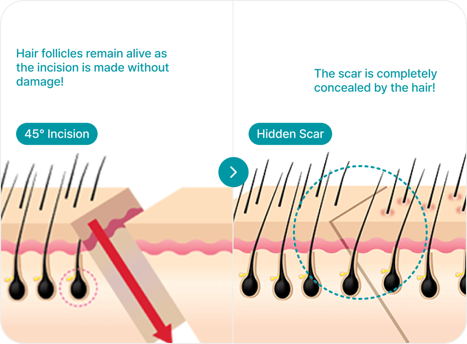 id Hospital - Forehead Reduction - 45° Incision Technique