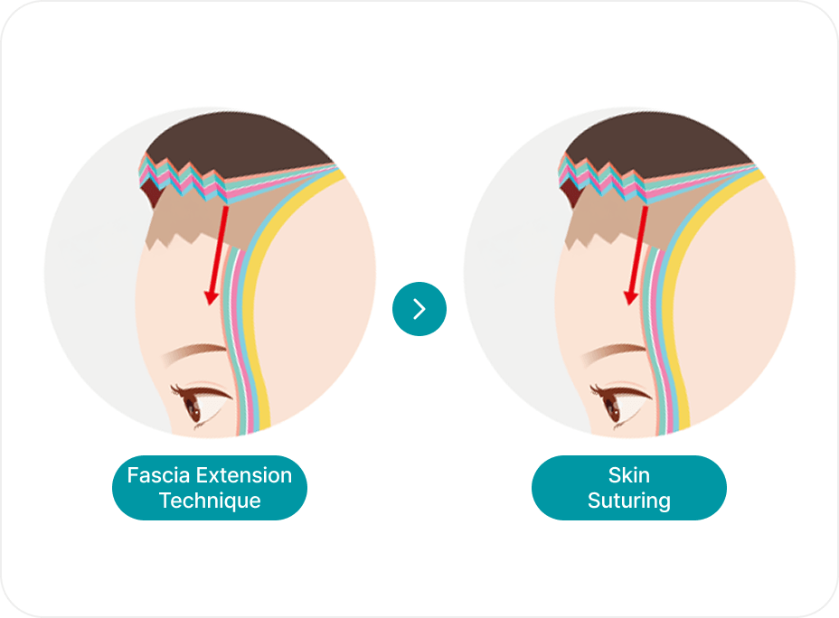 id Hospital - Forehead Reduction - Fascia Extension Technique