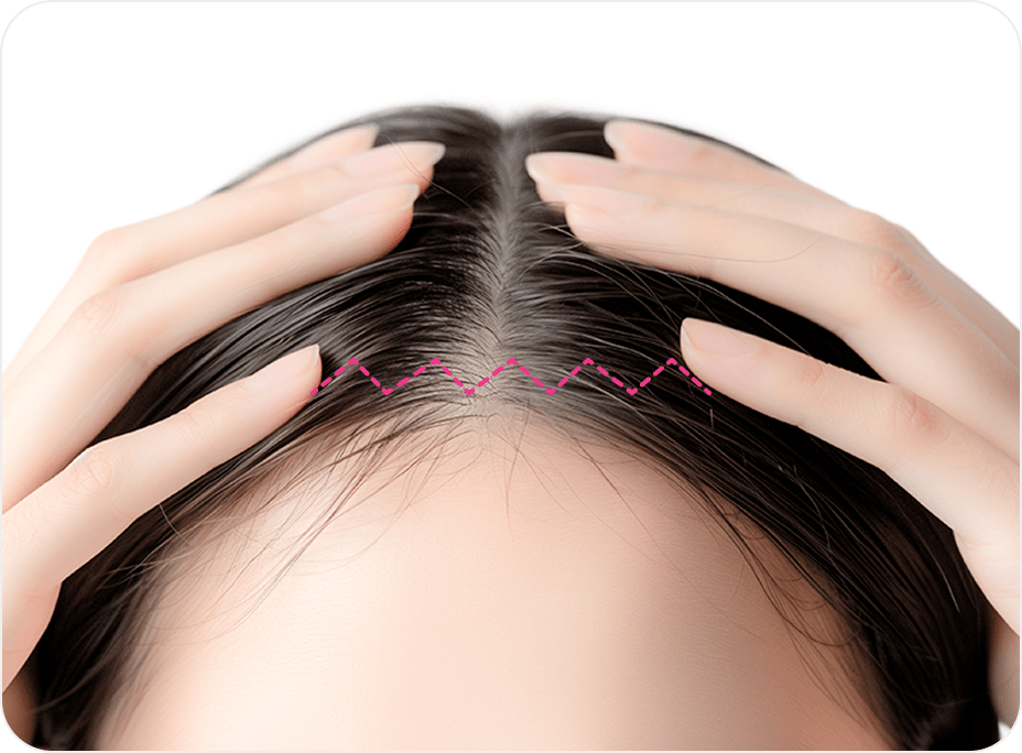 id Hospital - Forehead Reduction - Wave-shaped Incision Technique
