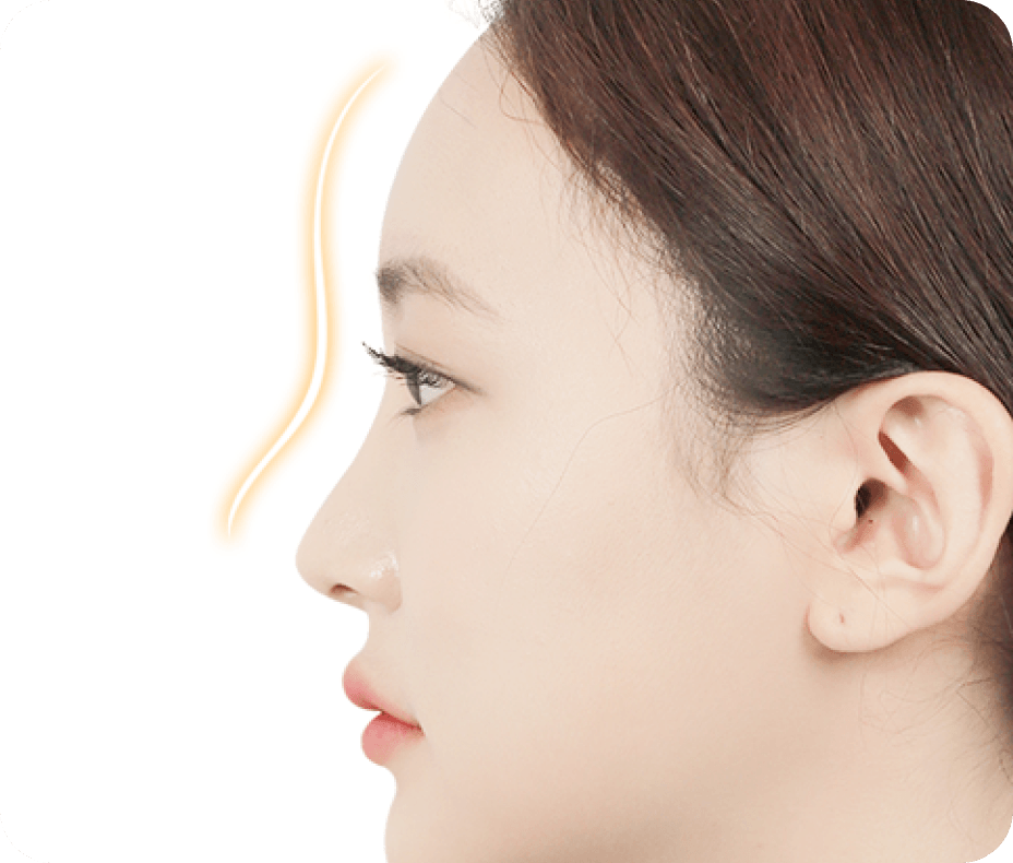 id Hospital - Forehead Reduction - Double-Fixation Implant After