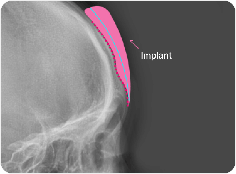 id Hospital - Forehead Reduction - Design and Implant Fabrication