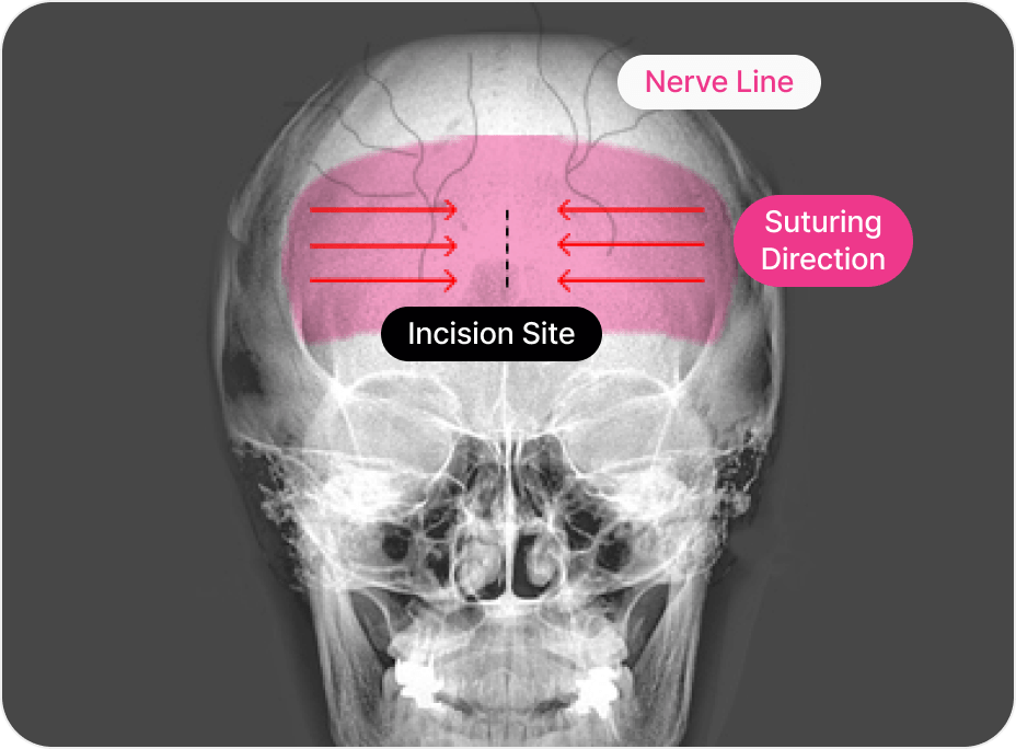 id Hospital - Forehead Reduction - Day of Surgery
