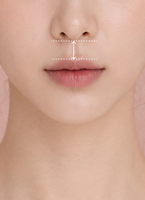 Philtrum Reduction (Up to 6 mm)