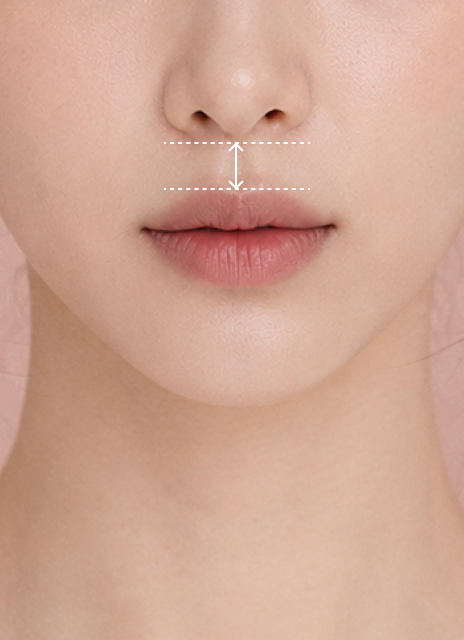 Philtrum Reduction (Up to 6 mm)