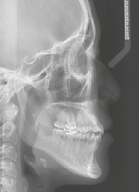 V-Logic Chin Surgery