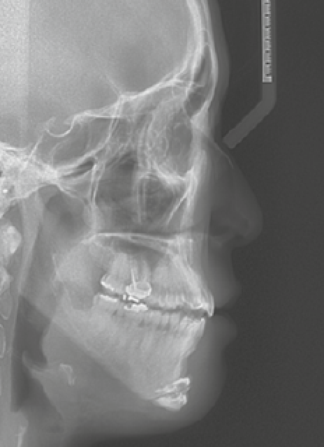 V-Logic Chin Surgery