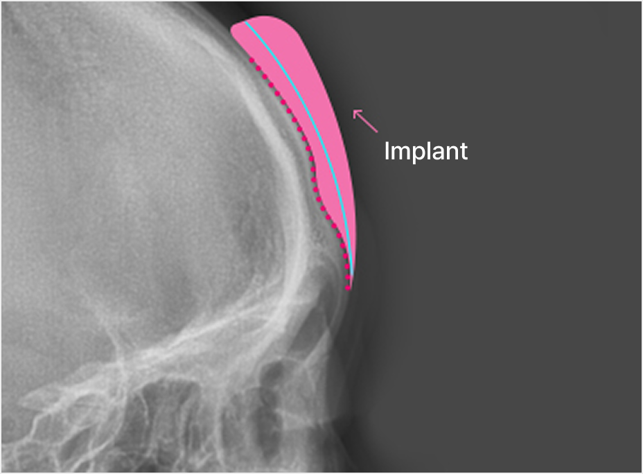 id Hospital - Forehead Reduction - Custom Implant Design