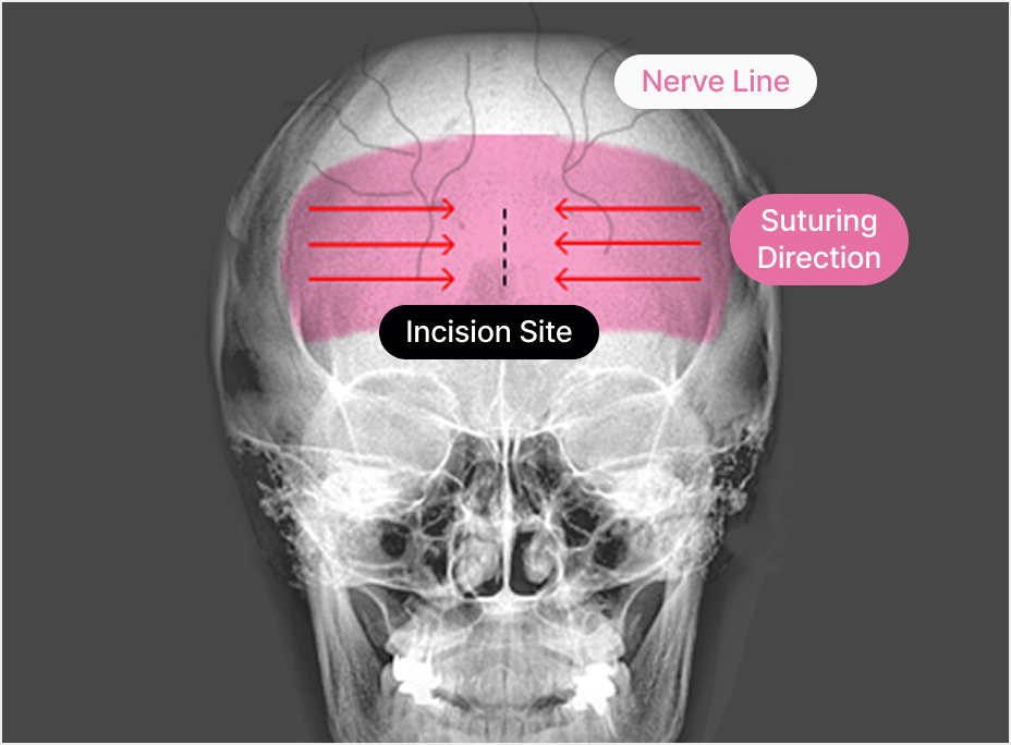 id Hospital - Forehead Reduction - Day of Surgery Incision Design