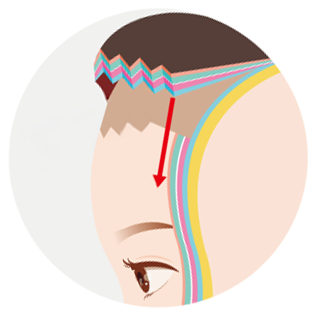 id Hospital - Forehead Reduction - Fascia Extension Technique