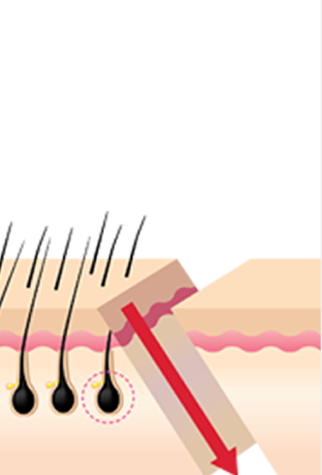 id Hospital - Forehead Reduction - 45° Incision Technique