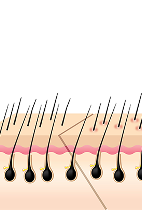 id Hospital - Forehead Reduction - Hidden Scar Result