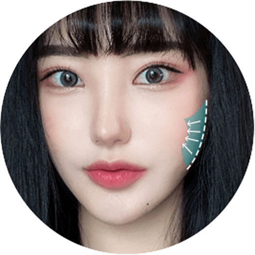 id Hospital - 3 Types of Facial Contouring - Sharper V-Line