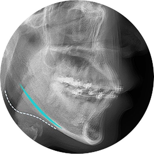 id Hospital - 3 Types of Facial Contouring - Smooth, Defined Jawline