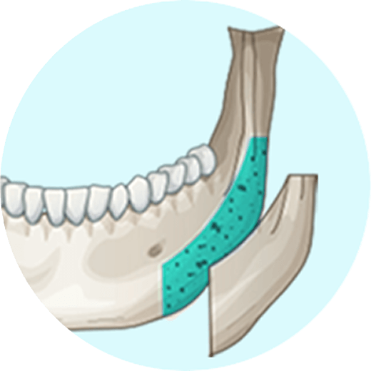 id Hospital - 3 Types of Facial Contouring - Slim Removal to the Bone's Thickness