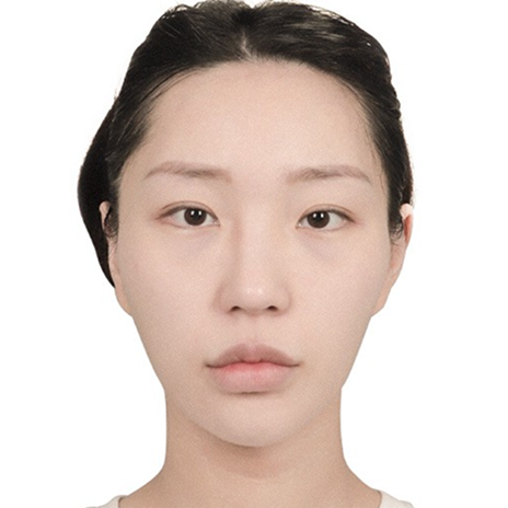 Zygoma before