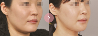 Secondary Mandibular Contouring Surgery