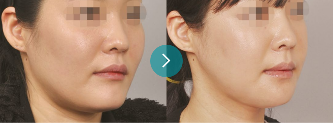 Secondary Mandibular Contouring Surgery