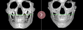 Secondary Zygoma Reduction
