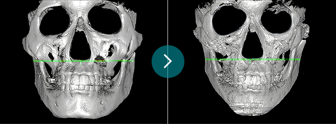 Secondary Zygoma Reduction