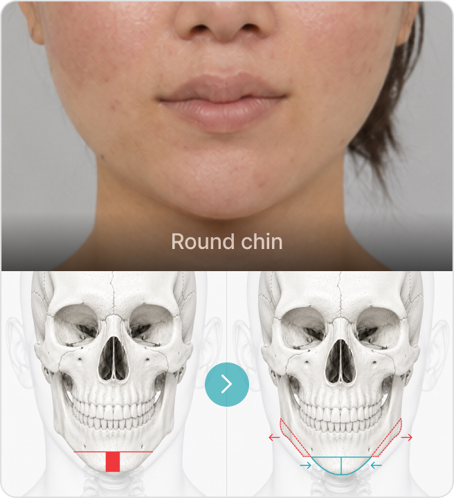 Round chin
