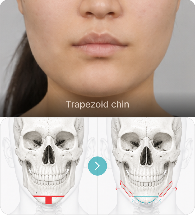 Trapezoid chin