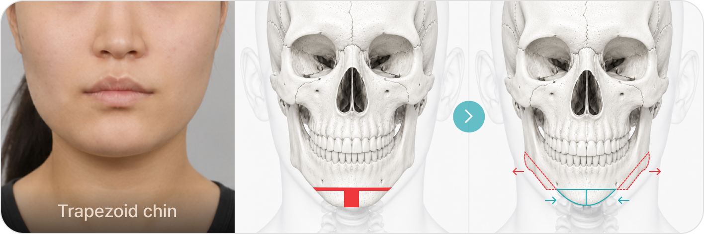 Trapezoid chin